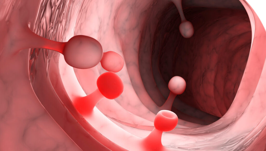 Pólipos colorrectales