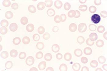 ¿Cómo se manifiesta clínicamente la anemia megaloblástica?