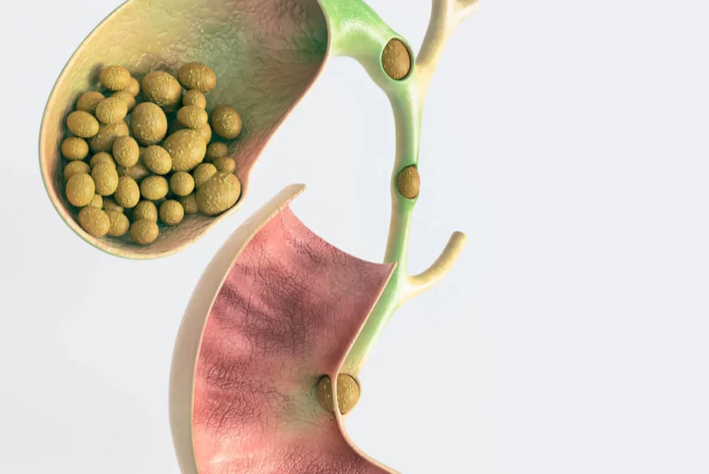 ¿Qué características tienen los cálculos biliares de pigmento?