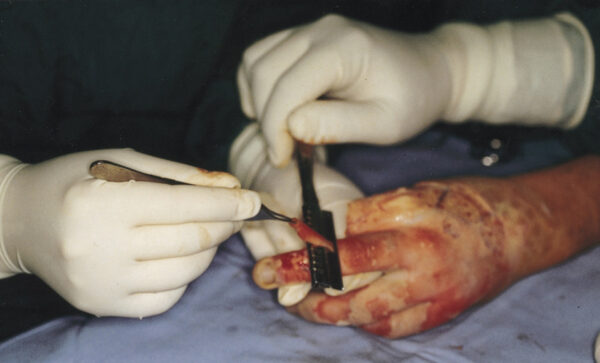 ¿Cómo es la escisión de lesiones por quemaduras?