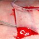 ¿Cuáles son los tipos de injertos utilizados en quemaduras?