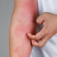 ¿Cómo se manifiesta la dermatitis atópica?