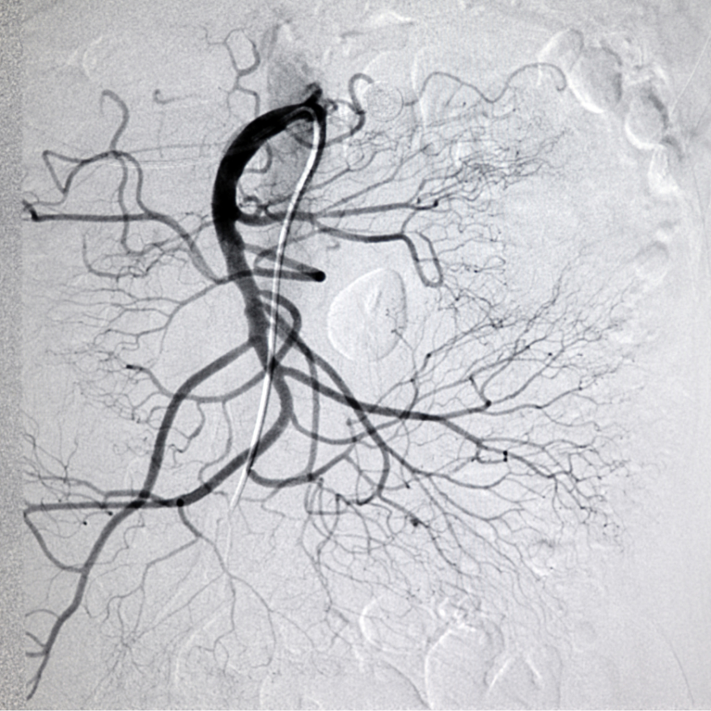 ¿Cuál es la causa de la arteriopatía mesentérica?