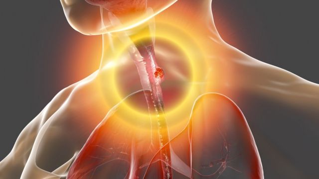 ¿Cuáles son los factores de riesgo para padecer cáncer esofágico?