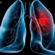 ¿Qué son los abscesos pulmonares?