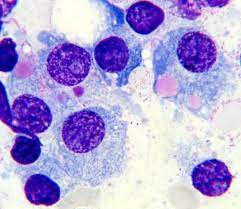 ¿Cuáles son las neoplasias de las células plasmáticas?