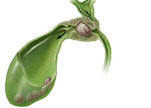 ¿Cuál es la causa de la colecistitis aguda?