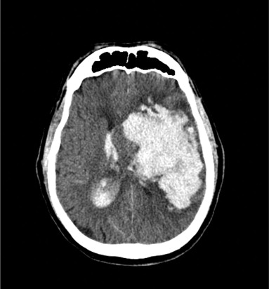 ¿Qué es la hemorragia intracerebral?