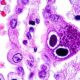 ¿Qué causa la infección por citomegalovirus?