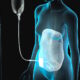 ¿Cuál es la complicación más frecuente de la diálisis peritoneal?