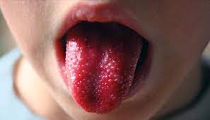 ¿Qué es la enfermedad de Kawasaki?