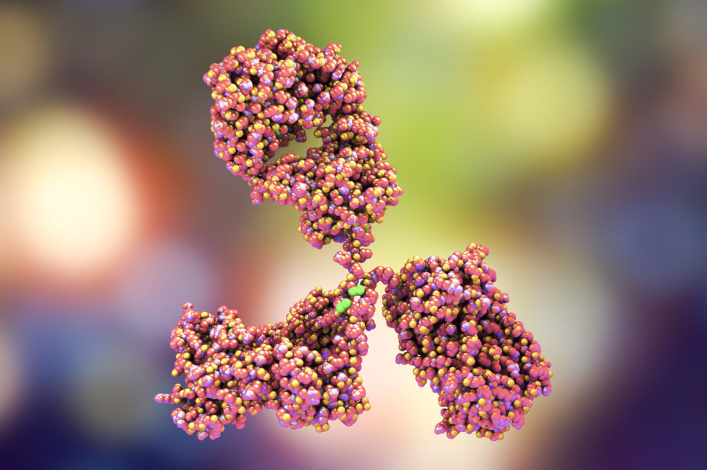 ¿Qué es la glomerulopatía por IgA?