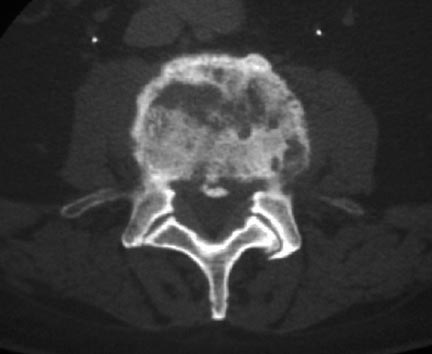 ¿Qué causa la osteomielitis vertebral?
