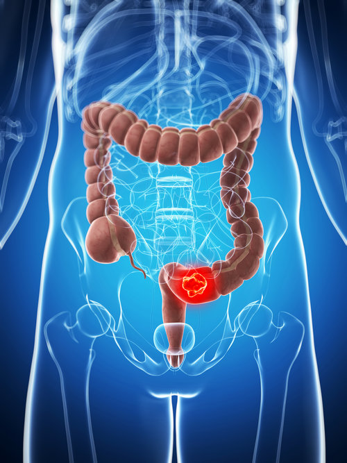 Factores de riesgo para cáncer de colon