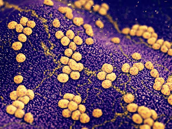 ¿Qué es la osteomielitis por Staphylococcus aureus?