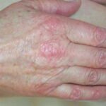 ¿Cómo se manifiesta la dermatomiositis?