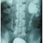 ¿Cuáles son las causas de obstrucción de las vías urinarias?