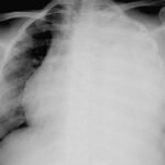 ¿Qué es un derrame pleural?