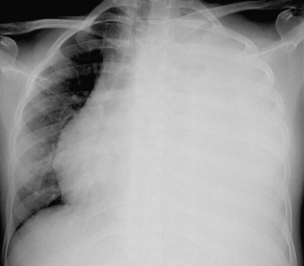 ¿Qué es un derrame pleural?