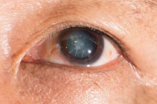 ¿Qué son las cataratas?