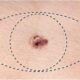 Tratamiento quirúrgico del melanoma