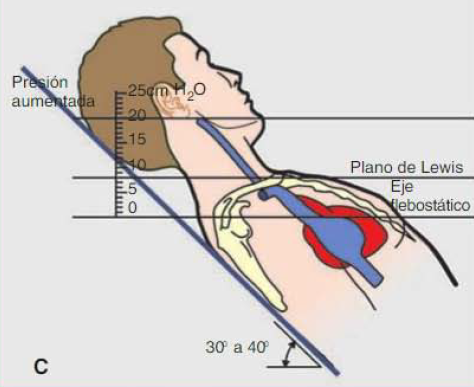 ¿Cuál es la utilidad de medir la presión venosa yugular?
