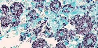 ¿Qué es la histoplasmosis?