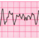 ¿Qué es la fibrilación ventricular?