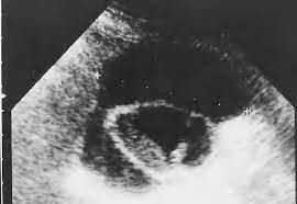 ¿Por que se forma un biloma?