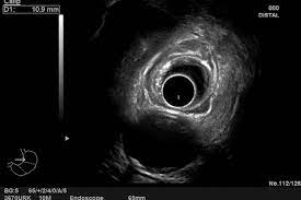¿Qué es la ecografía endoscópica?