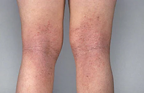 Critérios clínicos para el diagnóstico de dermatitis atópica