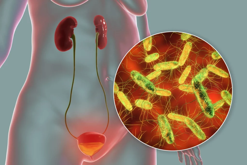 ¿Qué es la bacteriuria?
