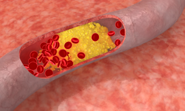 ¿Cuáles son los factores de riesgo de la ateroesclerosis?