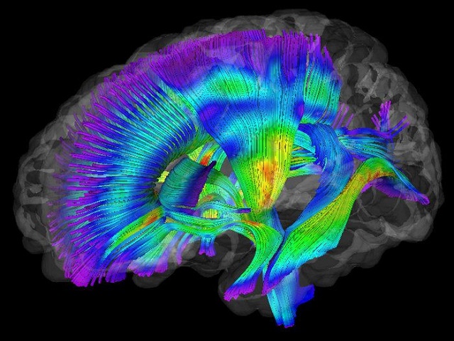 tractografía por resonancia magnética