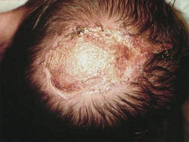 ¿Qué es la aplasia cutis?