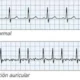 ¿Qué es la fibrilación auricular?