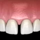 ¿Qué es diastema?