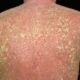Eritrodermia exfoliativa