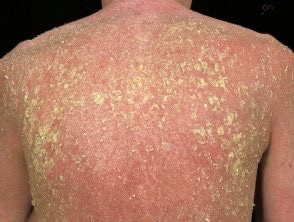 Eritrodermia exfoliativa