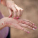 Características de la dermatitis por contacto