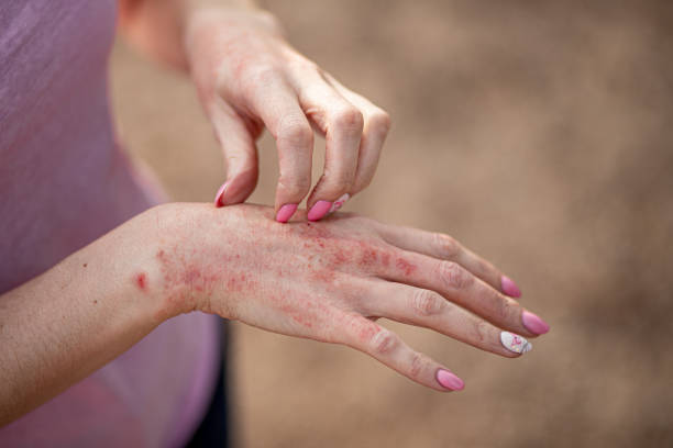 Características de la dermatitis por contacto