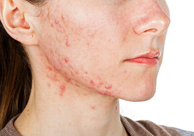 Características del acné vulgar