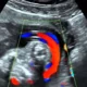 ¿Qué es el ultrasonido doppler?