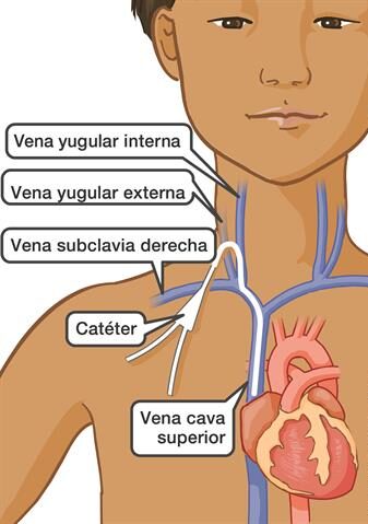 Sitios de acceso para catéter venoso central
