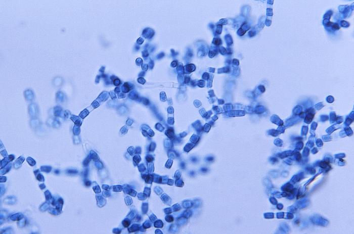 ¿Cuándo debe sospecharse coccidioidomicosis?