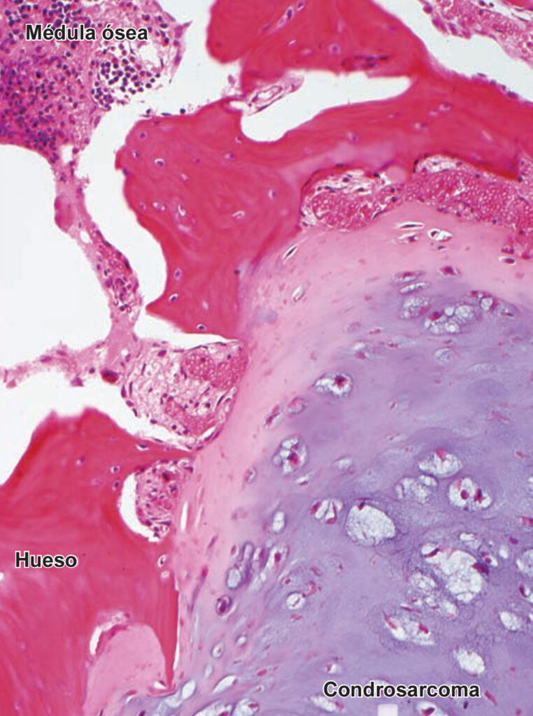¿Qué son los condrosarcomas?