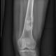 Clasificación del osteosarcoma
