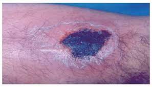 ¿Que es loxoscelismo?