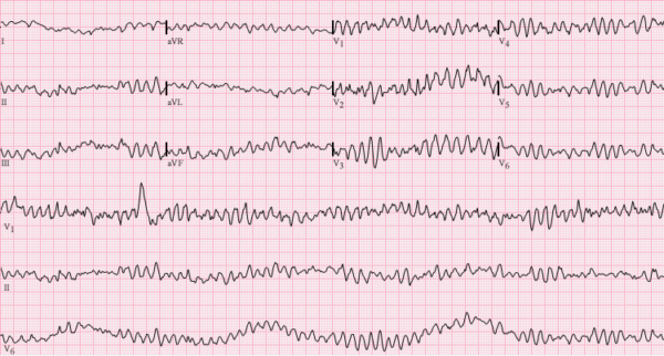 Tratamiento de urgencia de la taquicardia/fibrilación ventricular