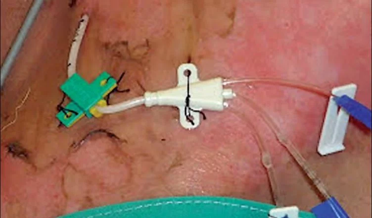 Infección del catéter venoso central